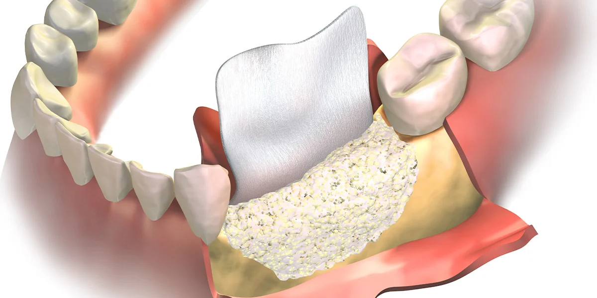 veneers