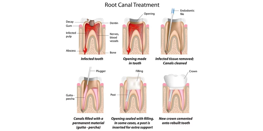 tooth bone graft