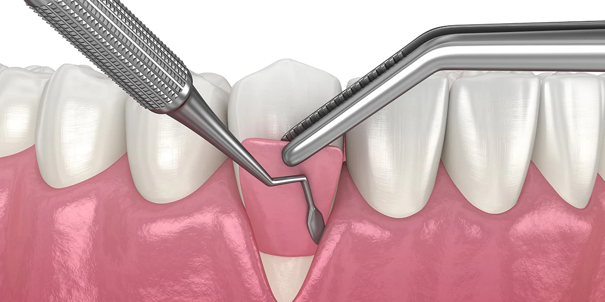 invisalign