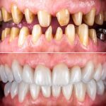 replacement tooth cost